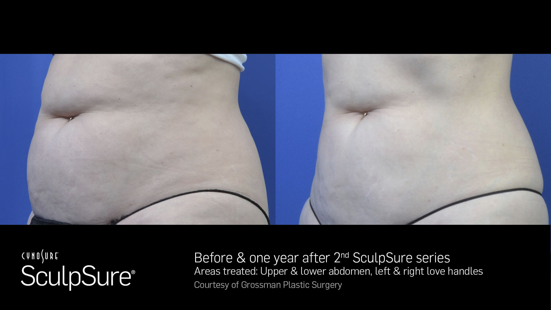 SculpSure-Core-Before-and-After--Female-14