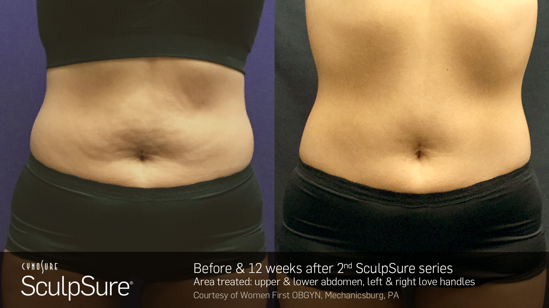 SculpSure-Core-Before-and-After--Female-17