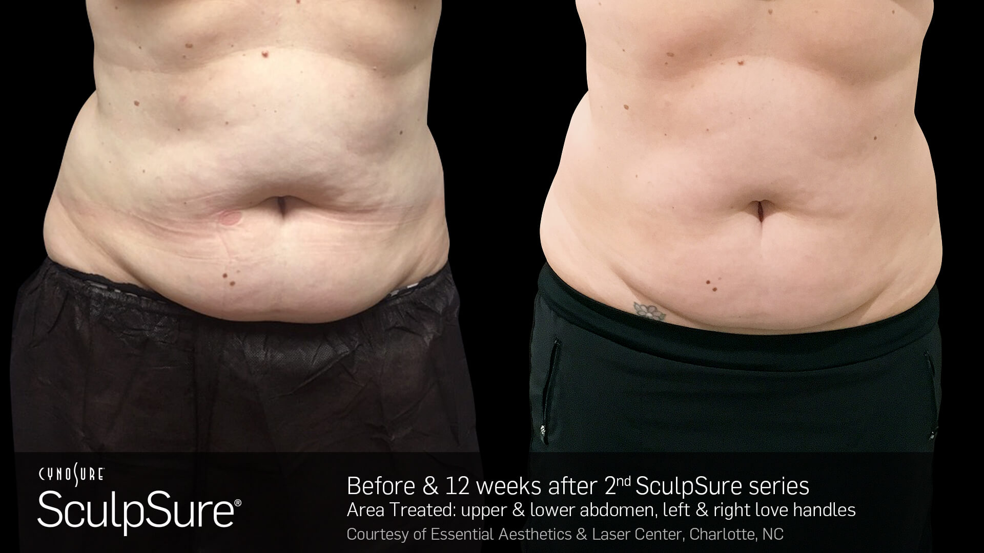 SculpSure-Core-Before-and-After--Female-18